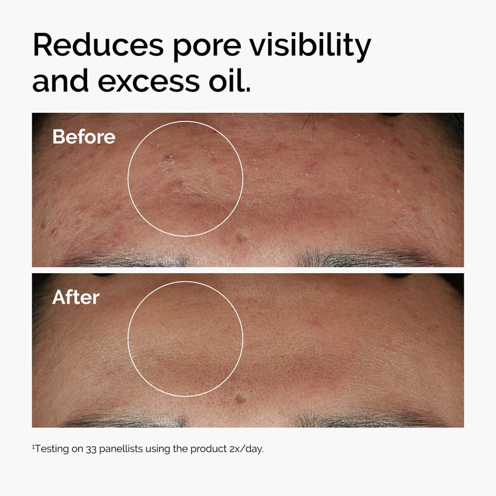 niacinamide-10-zinc-1-y6 ord-niacinamide-zinc-blemish-serum-before-after-pores.jpg