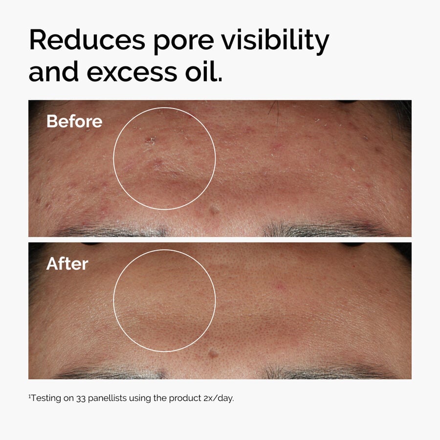 niacinamide-10-zinc-1-y6 ord-niacinamide-zinc-blemish-serum-before-after-pores.jpg