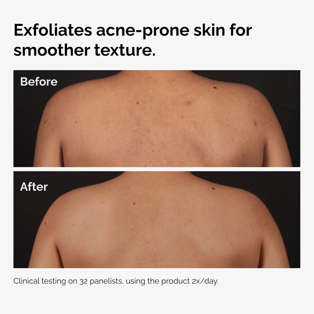 salicylic-acid-0-5-body-serum-o8 ord-salicylic-acid-body-serum-before-after-graphic-NA.jpg