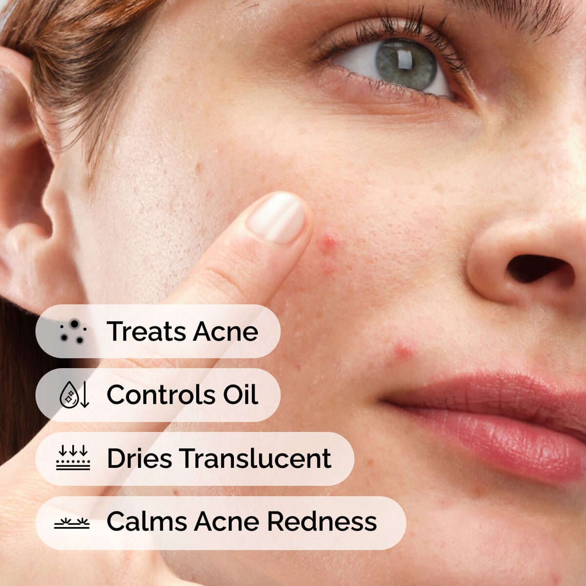 sulfur-10-powder-to-cream-concentrate-j5 ord-sulfur-10pct-powder-to-cream-concentrate-model-application-with-benefits-acne.jpg