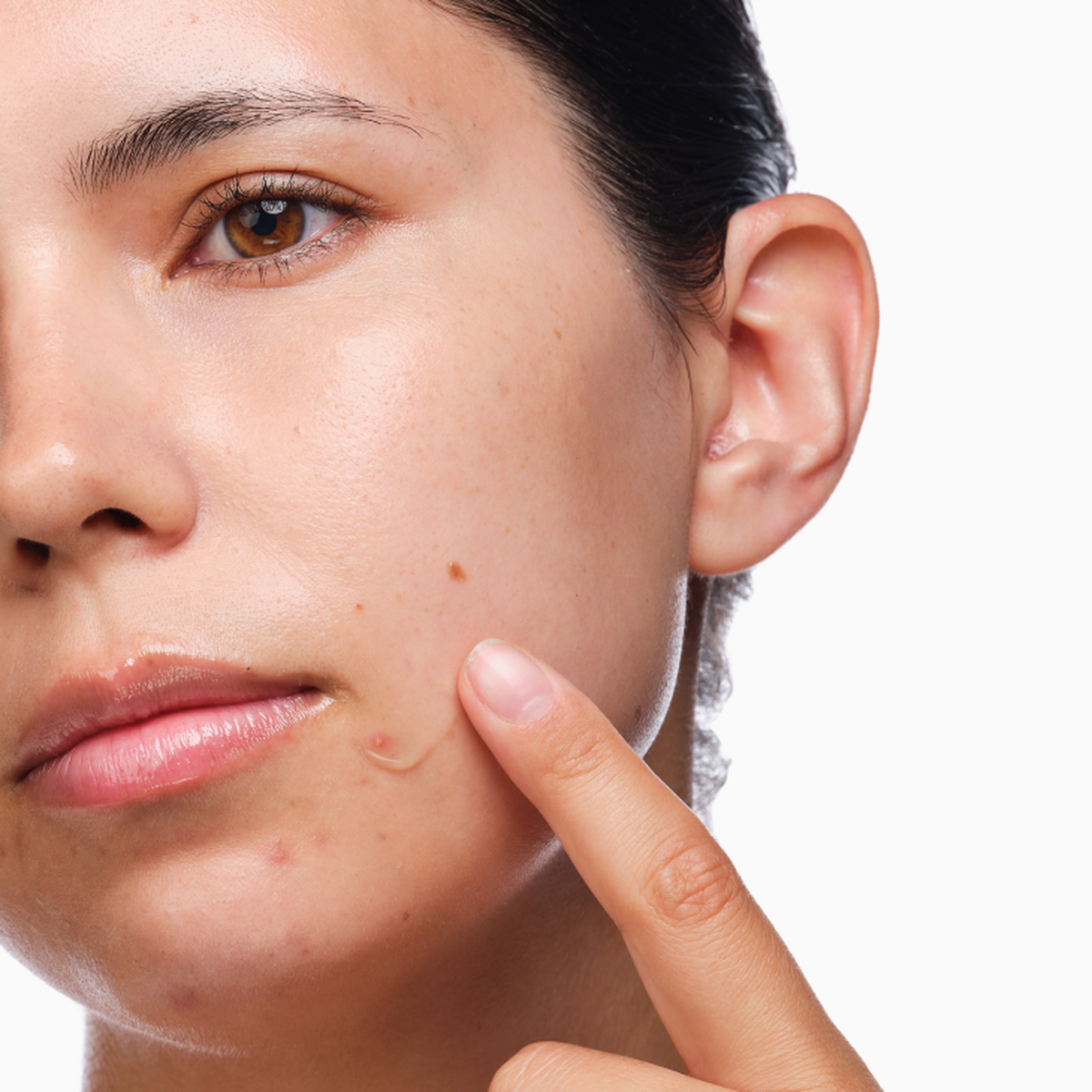 the-acne-set-c9 rdn-the-acne-set-application.png